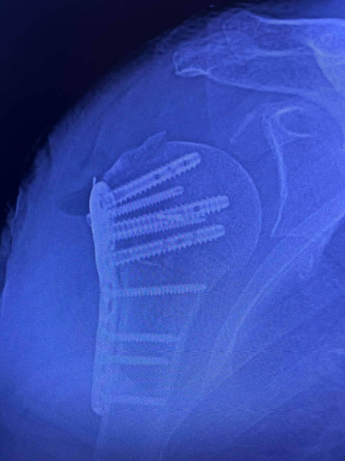 Radiografía — Fractura de húmero proximal (1)
