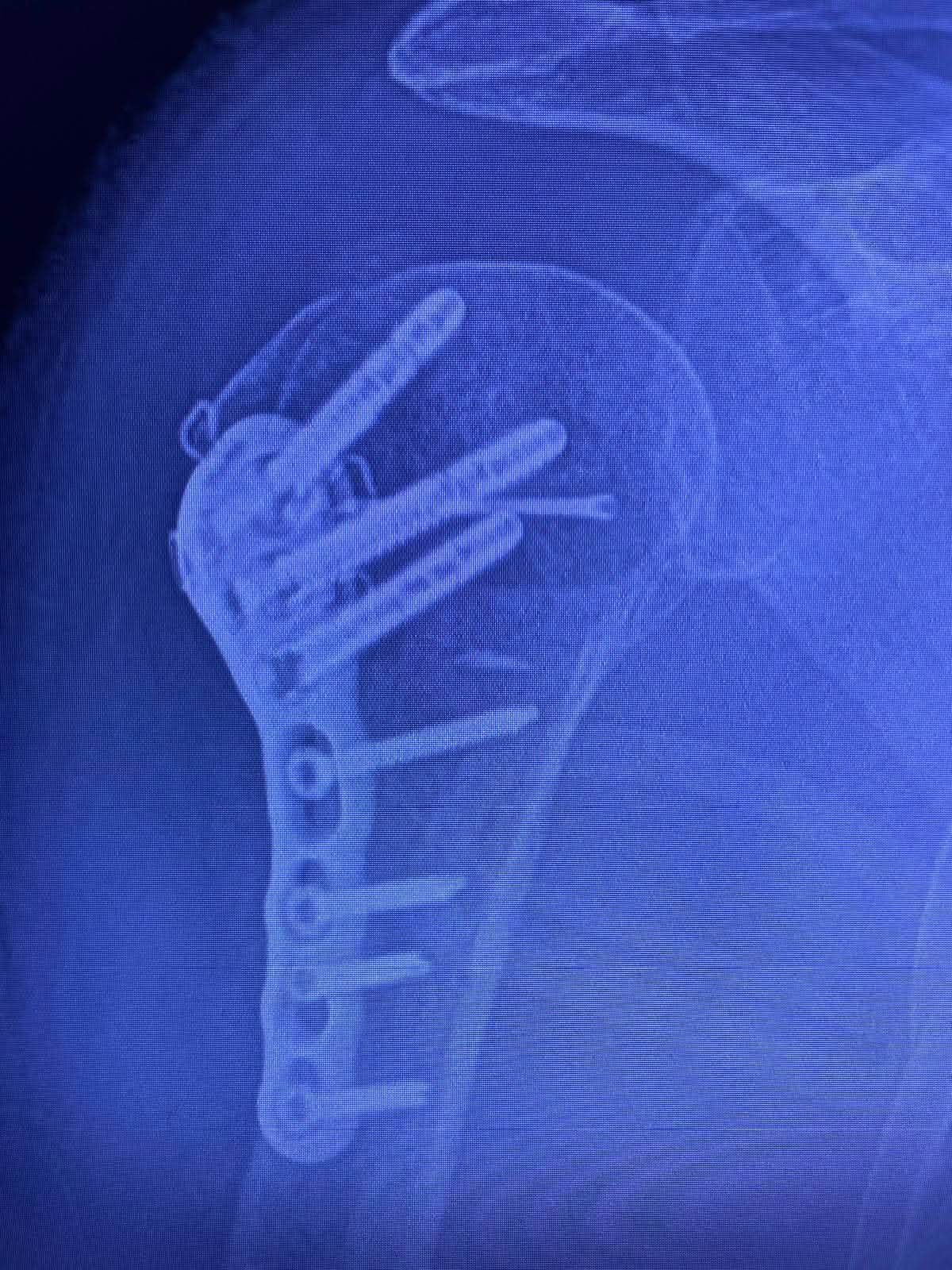 Radiografía — Fractura de húmero proximal (2)