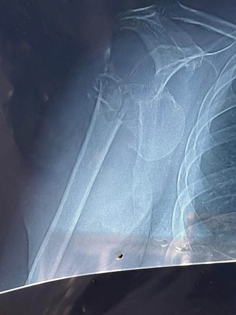 Radiografía — Fractura de húmero proximal (3)